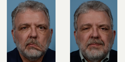 Facial Reconstructive Surgery before and after photo