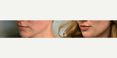 Microneedling before and after photo