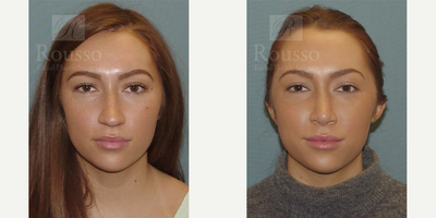 Rhinoplasty before and after photo