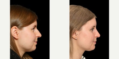 Rhinoplasty before and after photo