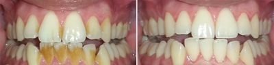 Tooth Repair before and after photo