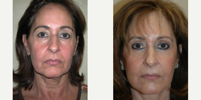 Eyelid Surgery before and after photo