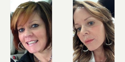 Facelift before and after photo