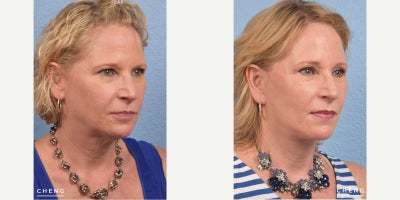 Facial Fat Transfer before and after photo