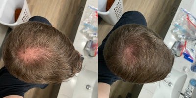 Hair Loss Treatment before and after photo