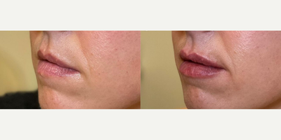 Lip Fillers before and after photo