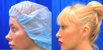 Revision Rhinoplasty before and after photo