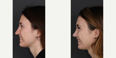 Rhinoplasty before and after photo