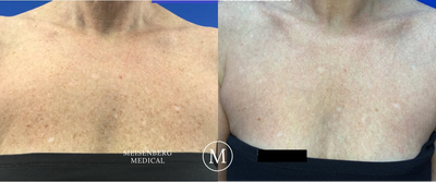 Skin Rejuvenation before and after photo