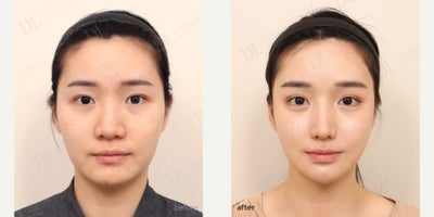 Cheekbone Reduction before and after photo