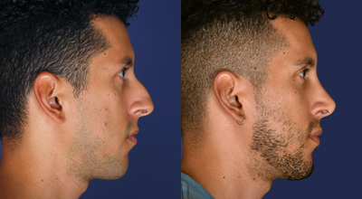 Dermal Fillers before and after photo