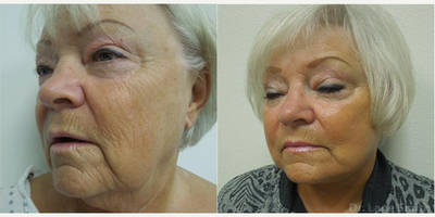 Facelift before and after photo