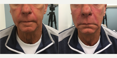 Restylane Lyft before and after photo
