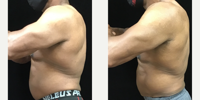 truFlex before and after photo