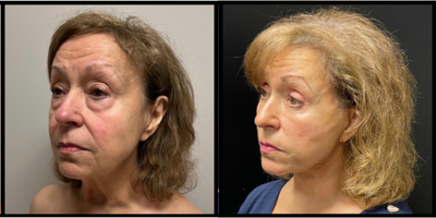 Eyelid Surgery before and after photo