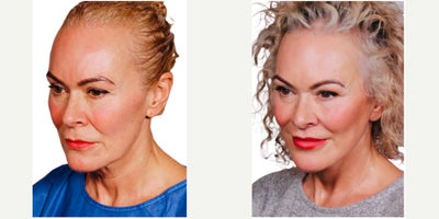 Facelift before and after photo
