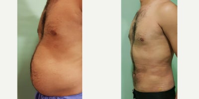 Liposuction before and after photo