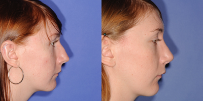Rhinoplasty before and after photo