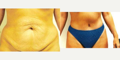 Tummy Tuck before and after photo