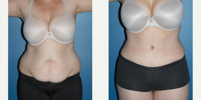 Tummy Tuck before and after photo