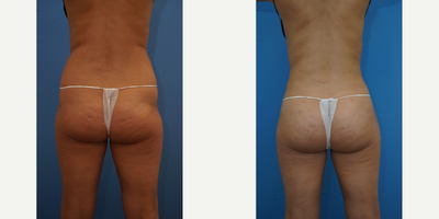 Brazilian Butt Lift before and after photo