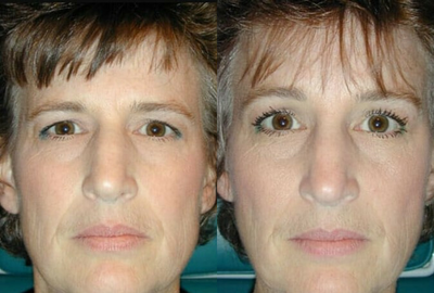 Brow Lift before and after photo