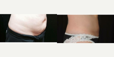 CoolSculpting before and after photo