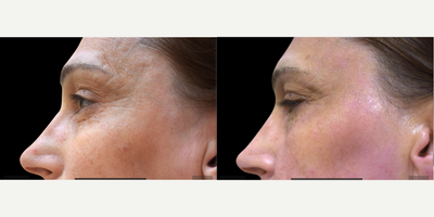 Exilis before and after photo