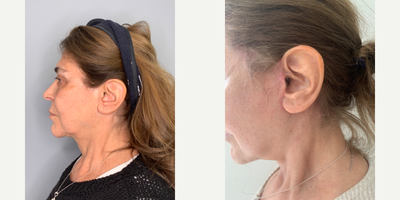 Facelift Revision before and after photo