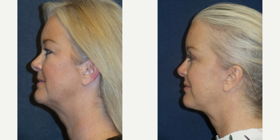 Facelift before and after photo