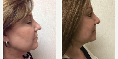 Facelift before and after photo
