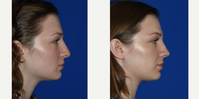 Revision Rhinoplasty before and after photo