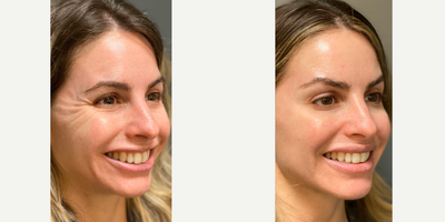 Botox before and after photo