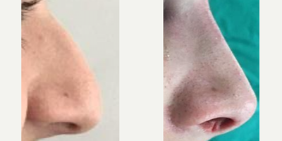 Rhinoplasty before and after photo