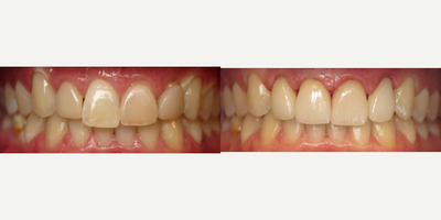 Dental Crown before and after photo