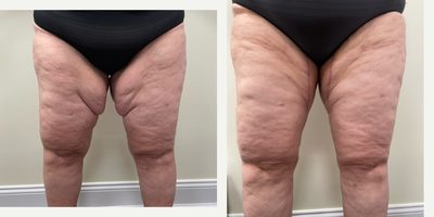 Liposuction before and after photo