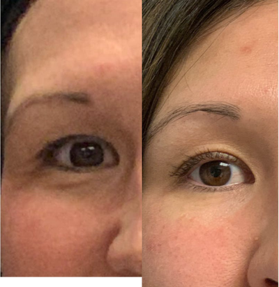ThermiSmooth Face before and after photo
