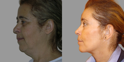 Deep Plane Facelift before and after photo