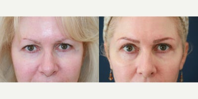 Eyelid Surgery before and after photo