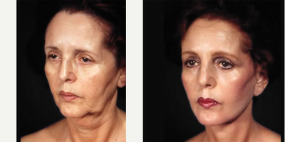 Facelift before and after photo