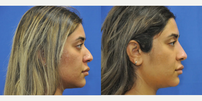 Nonsurgical Nose Job before and after photo