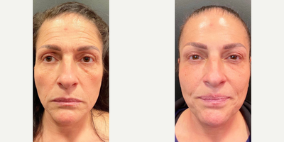 Botox before and after photo