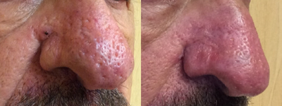 Laser Resurfacing before and after photo