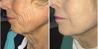 Facelift before and after photo
