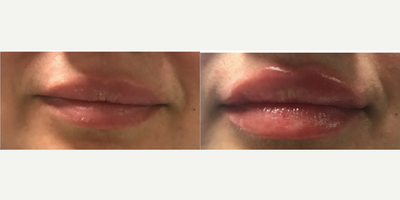 Lip Fillers before and after photo