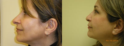Rhinoplasty before and after photo