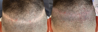 Scalp Micropigmentation before and after photo