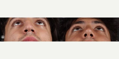 Septoplasty before and after photo