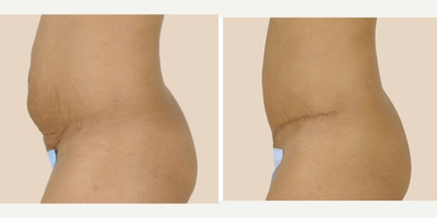 Tummy Tuck before and after photo