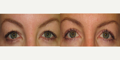 Eyelid Surgery before and after photo